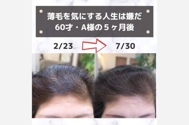 女性の薄毛改善のご相談は個室サロンの東京都日野市のル・トレフルへ