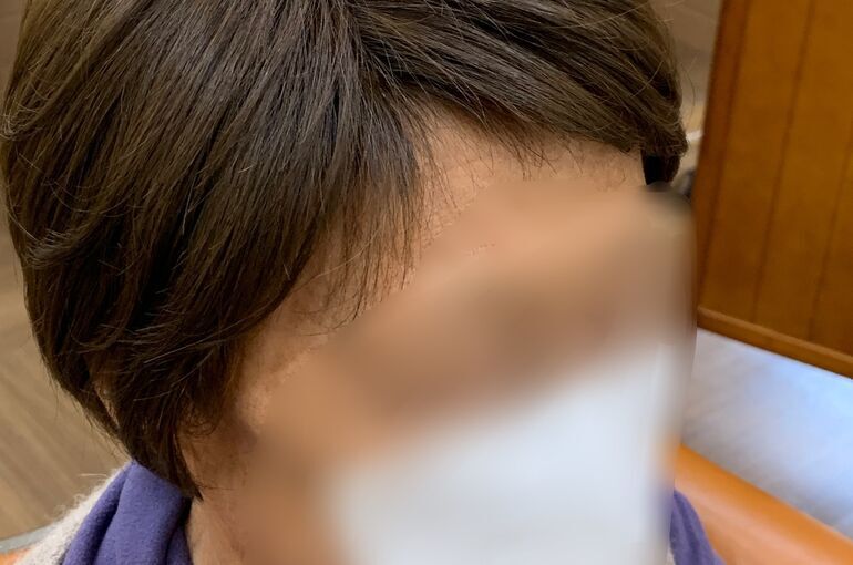 医療用ウィッグのメンテナンスと抗がん剤治療後の頭皮ケアは東京都日野市のル・トレフルへ